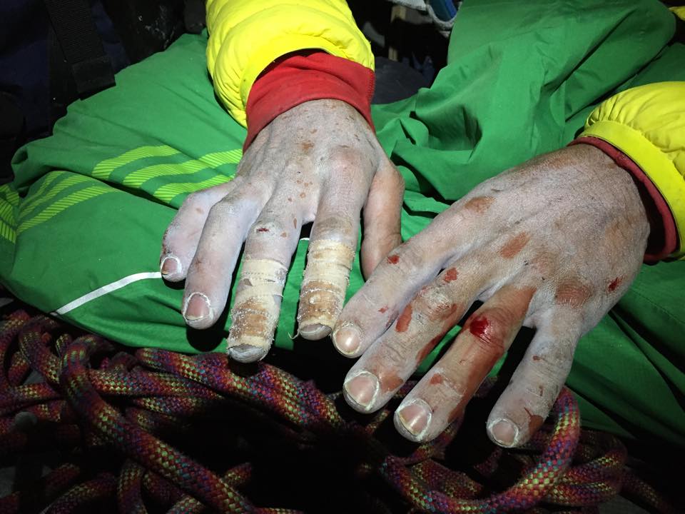 Kevin Jorgeson's hands after pitch 15  Photo Jorgeson's Facebook page
